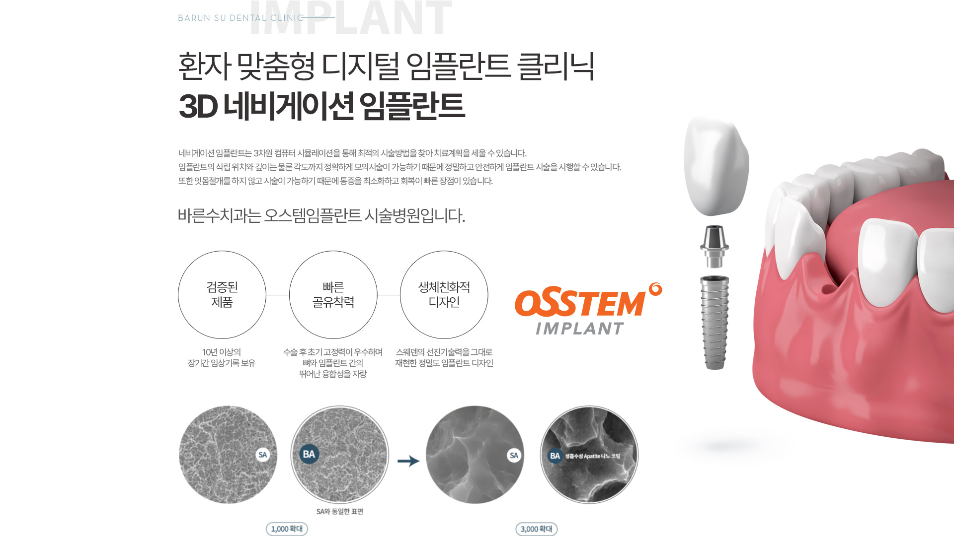 환자 맞춤형 디지털 임플란트 클리닉. 3D 네비게이션 임플란트