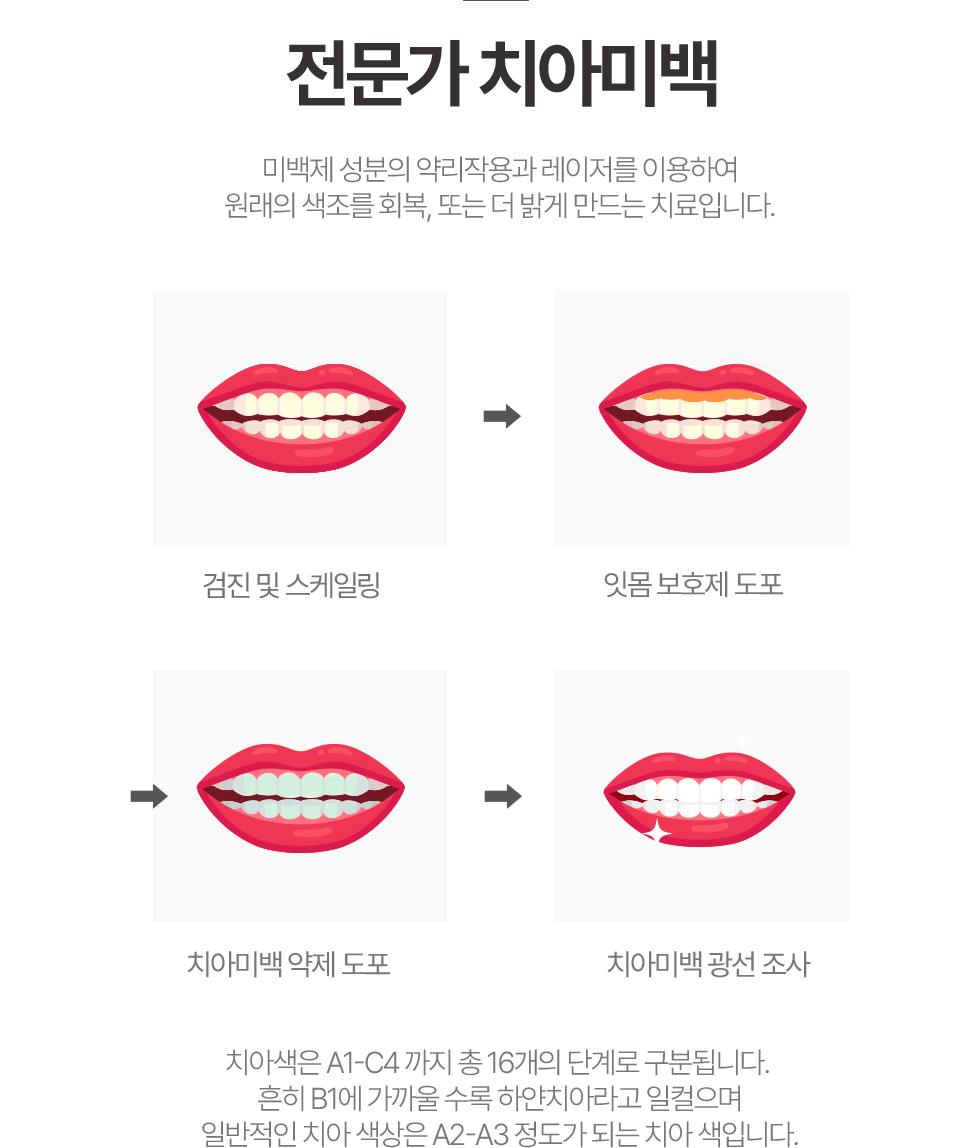 전문가 치아미백