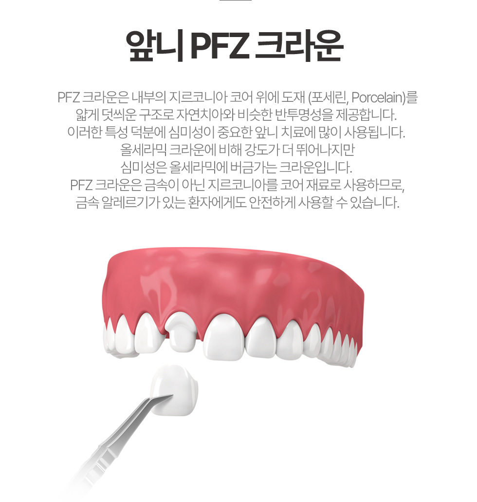 앞니 PFZ 크라운