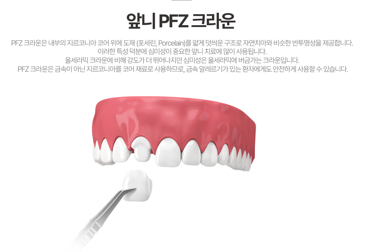 앞니 PFZ 크라운